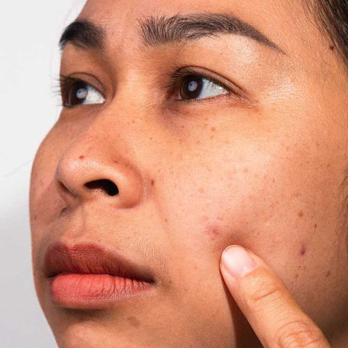Close-up of a person pointing to a blemish on their face.