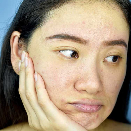 Woman with acne on her face, looking uncomfortable
