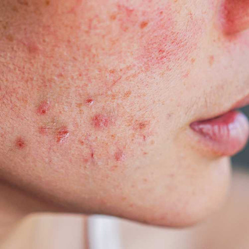 Close-up of a person's face with visible acne on the skin.